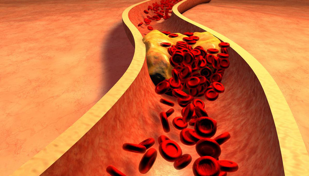 Cơ thể thiếu nước sẽ làm tăng nồng độ lipid trong máu, lâu ngày lượng lipid này tồn đọng trong thành mạch máu cản trở quá trình lưu thông máu. Từ đó máu sẽ không được vận chuyển đi các cơ quan khác, đặt biệt là tim.