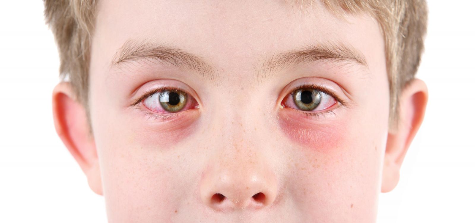 Bệnh đau mắt đỏ hay còn gọi khác nữa là bệnh viêm màng kết.